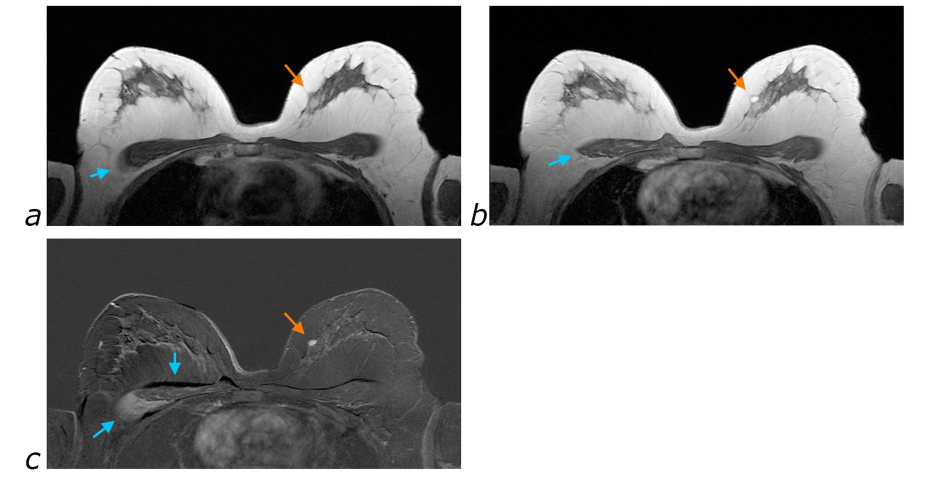 Fat Signal Improving MRI contrast: imaging water and fat | e-MRI