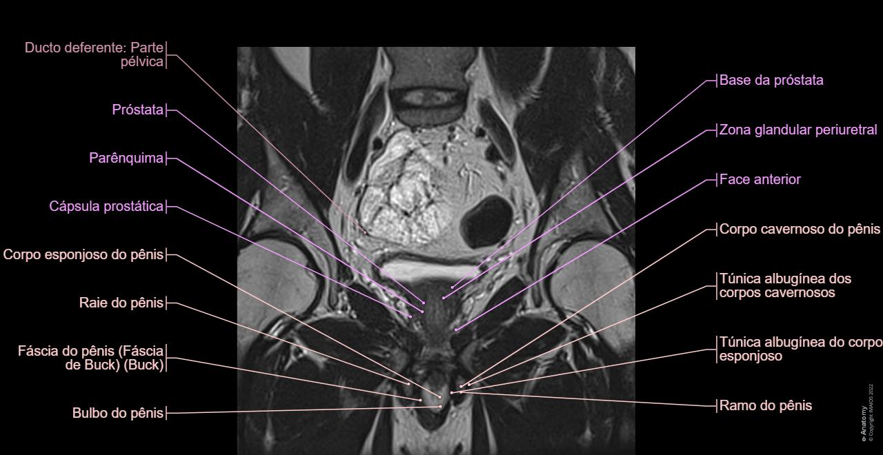 Pelve Anatomia Dos Musculos Pelvicos Ressonancia Magnetica