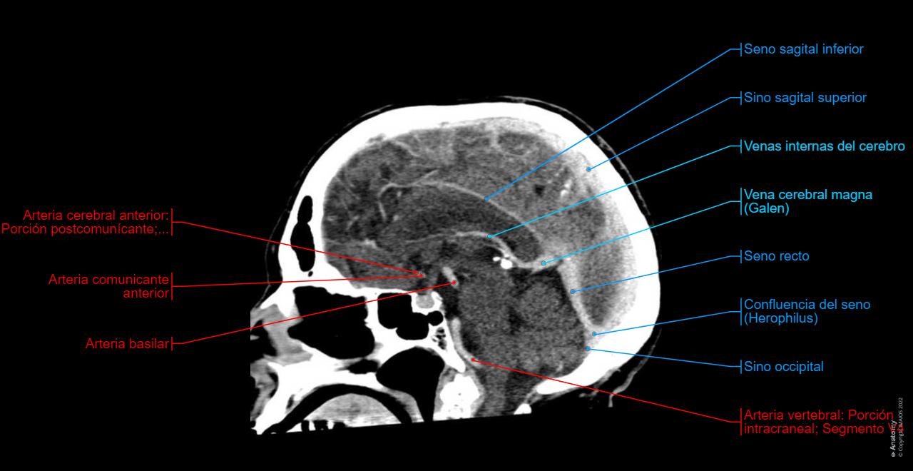 Tac Normal Tomografía Computarizada Del Cerebro
