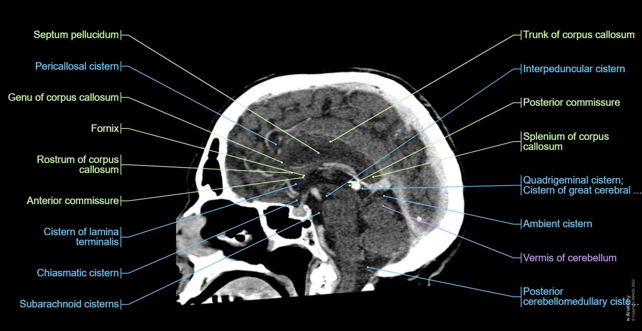 Anatomy of the brain and face: labeled CT - e-Anatomy