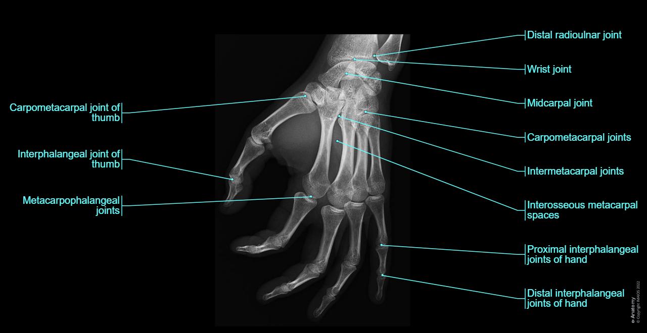 Normal Variant Hand Os Radiological anatomy of the upper limb : normal anatomy | e-Anatomy