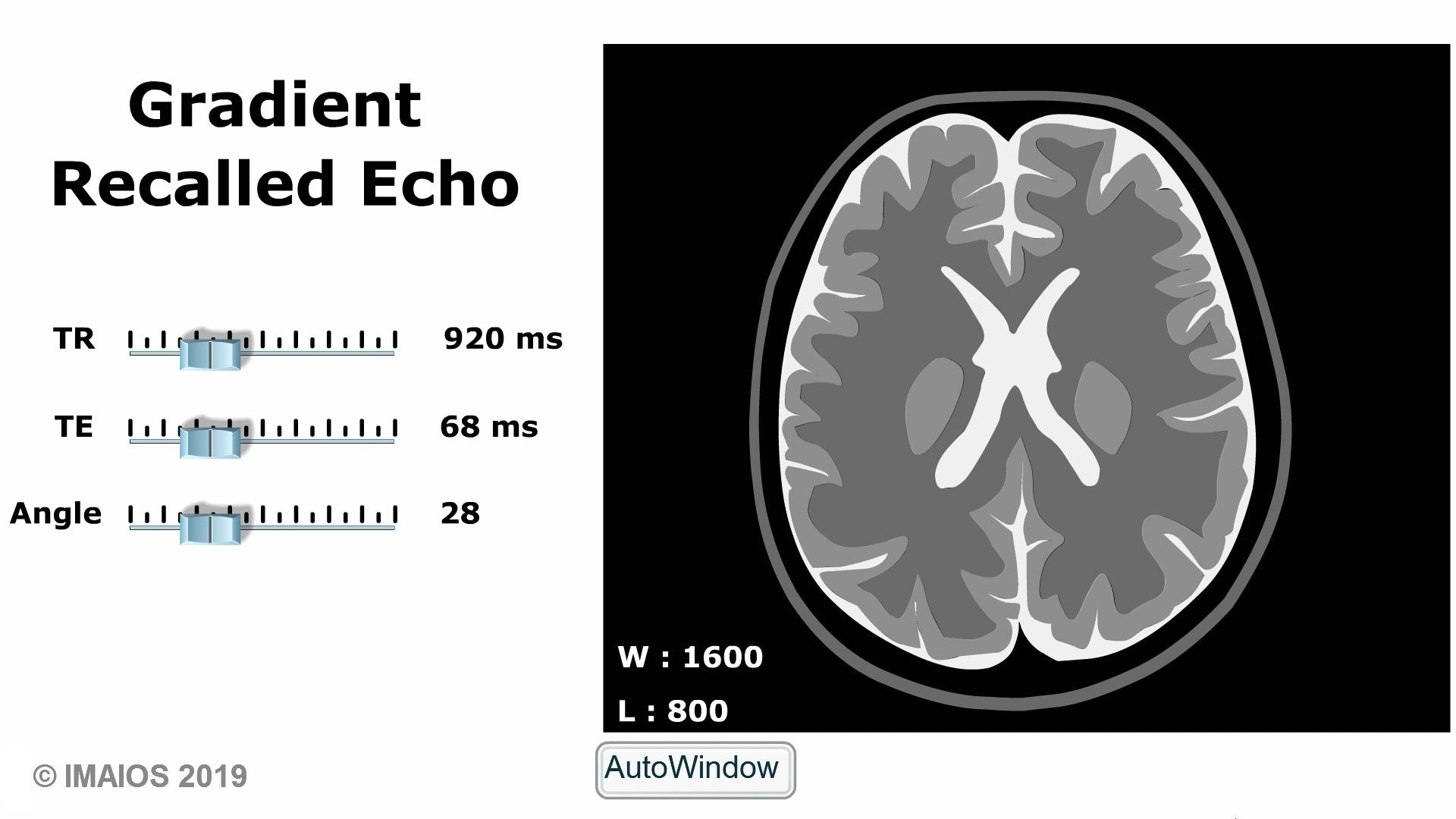 MRI Sequences: spoiled gradient echo sequences | e-MRI