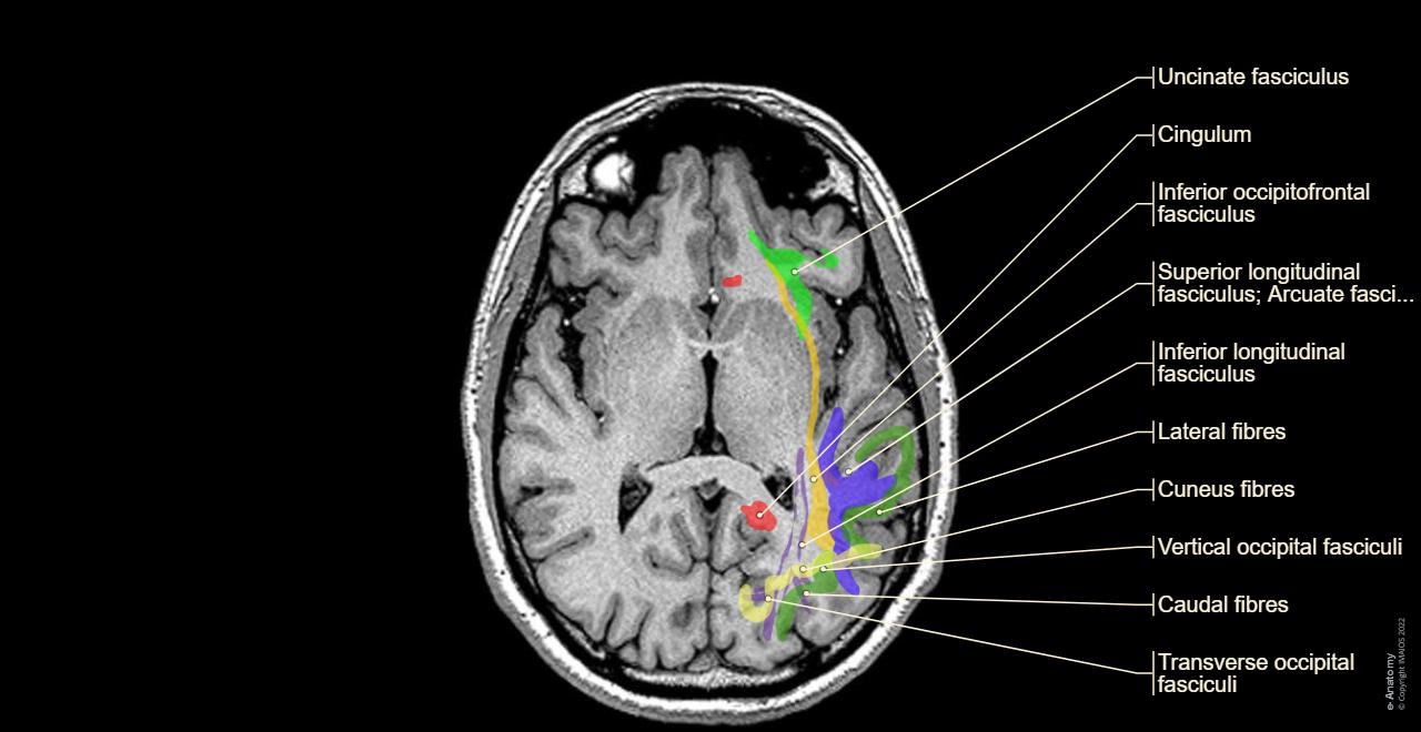 Normal Brain Mri Labeled Magnetic Resonance Images Of The Brain (MRI