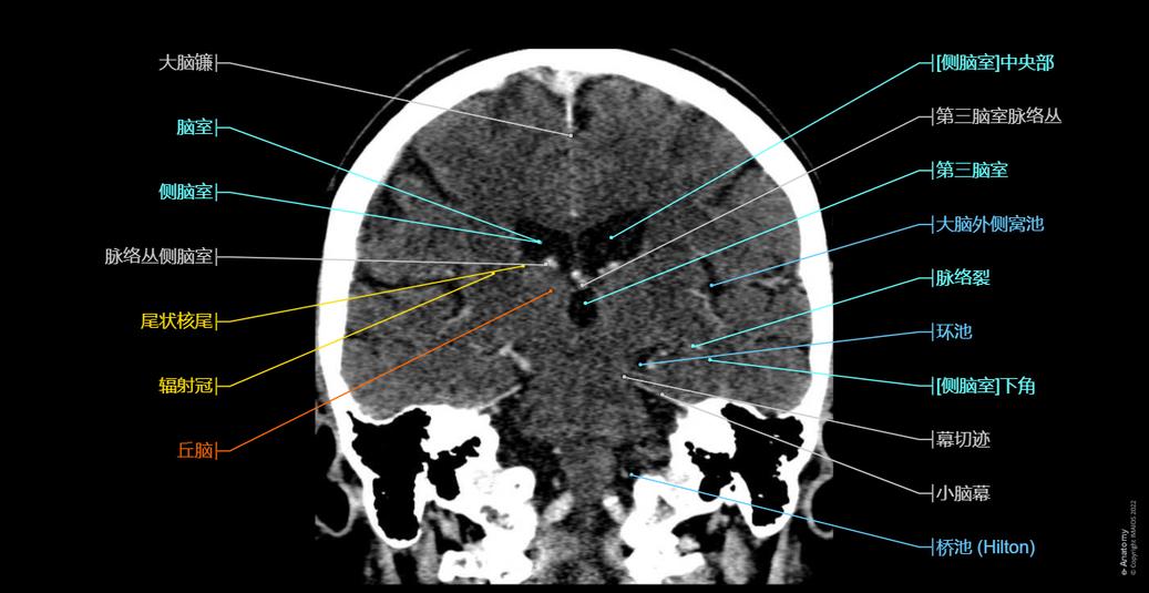头部 CT : 正常解剖 | e-Anatomy