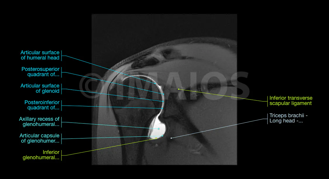 【裁断済】肩関節のMRI MRI GH joint : 読影ポイントと新しい知見 肩関節のMRI = MRI GH joint : 読影ポイントと新しい知見 肩関節