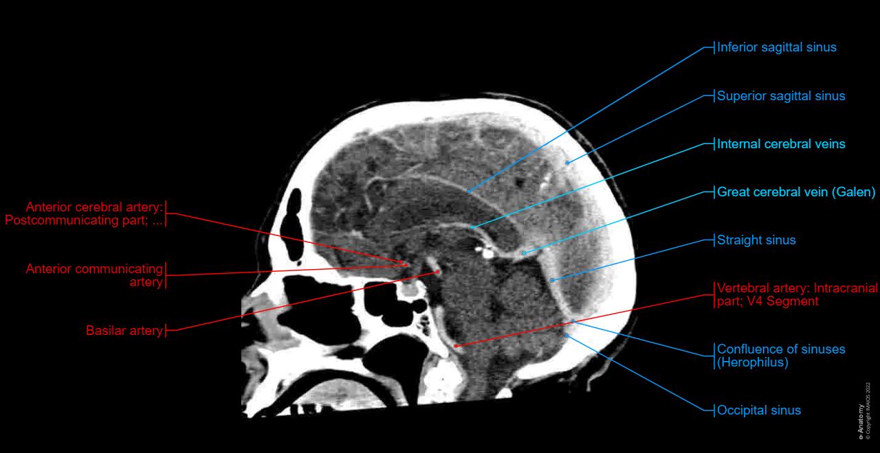 Normal Ct Anatomy Of Brain Radiological Anatomy Of The Brain Part I