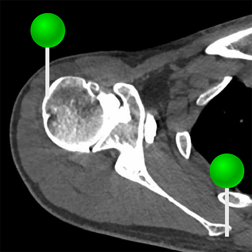 CT arthrogram of the shoulder joint: normal anatomy | e-Anatomy