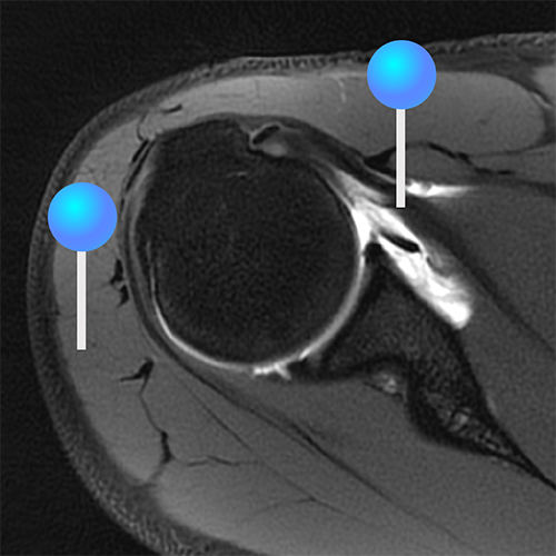 Shoulde Arthrogram Shoulder MR Arthrogram | e-Anatomy
