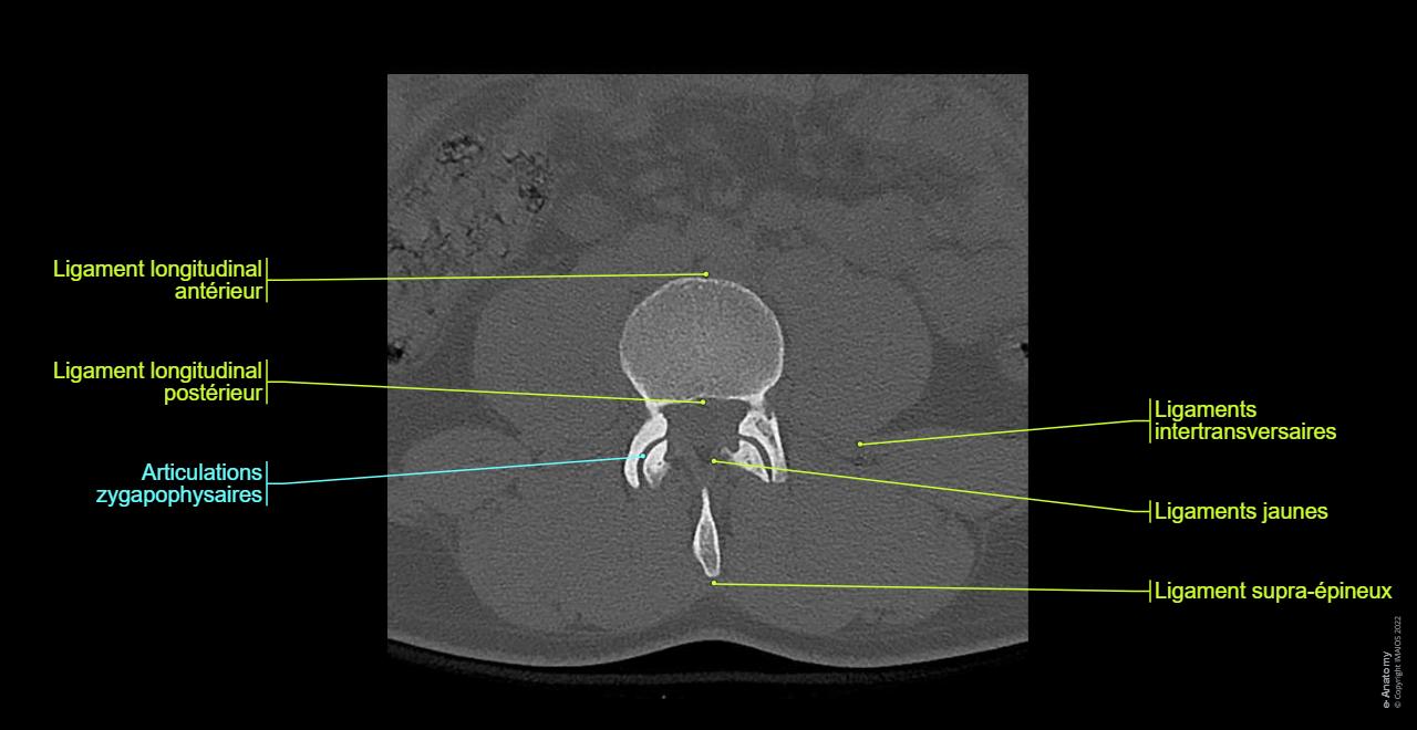 Rachis Lombaire TDM Anatomie Normale E Anatomy rachis-lombaire-tdm-anatomie-normale-e-anatomy
