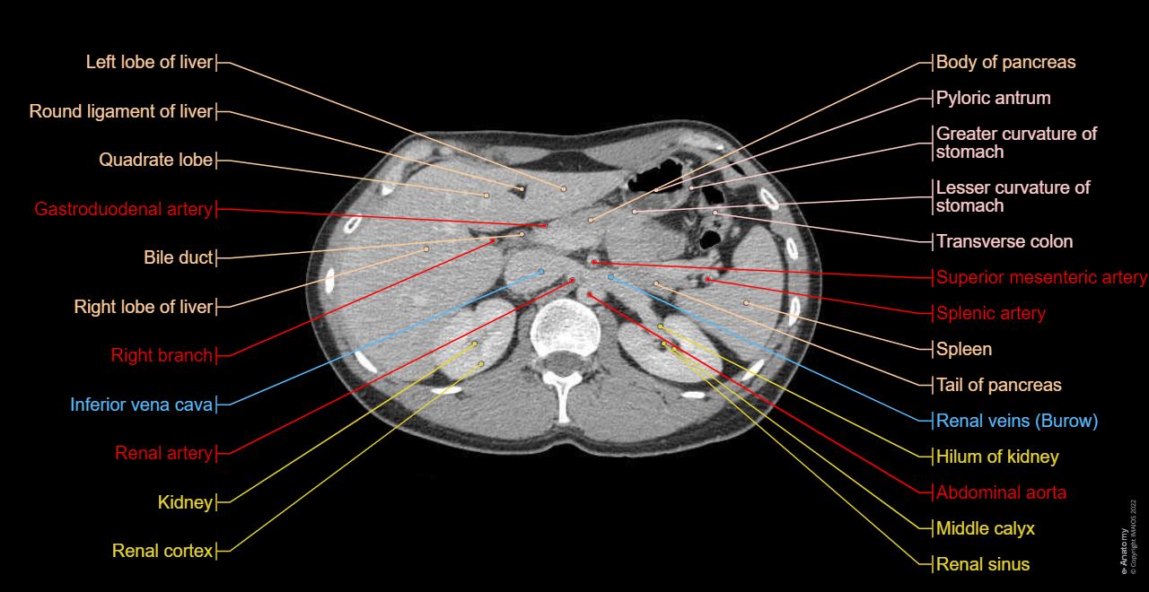 An Axial Slice Of A Ct Scan With Labeled Anatomical an-axial-slice-of-a-ct-scan-with-labeled-anatomical