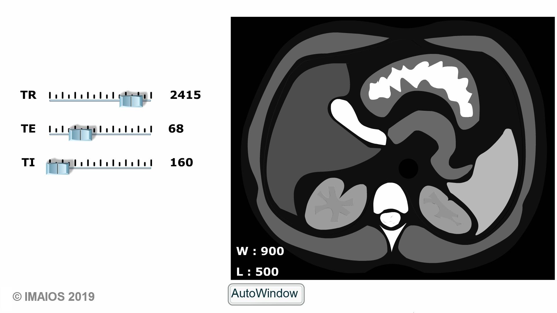 MRI sequences: Inversion Recovery, STIR and FLAIR | e-MRI