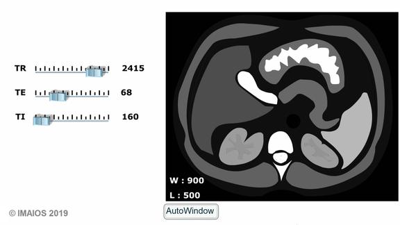Fat Signal Improving MRI contrast: fat signal suppression by STIR | e-MRI