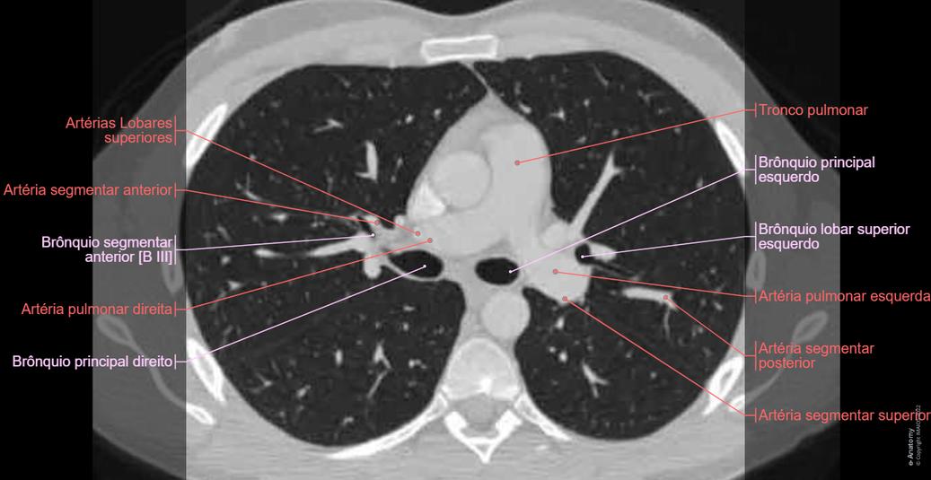 Anatomia Dos Pulm es Mediastino E Cora o Em TAC tomografia Tor cica anatomia-dos-pulm-es-mediastino-e-cora-o-em-tac-tomografia-tor-cica