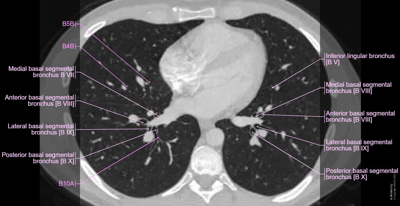 Lung Segments Ct Anatomy Right Lower Lobe Segmentation: CPAM In Extra