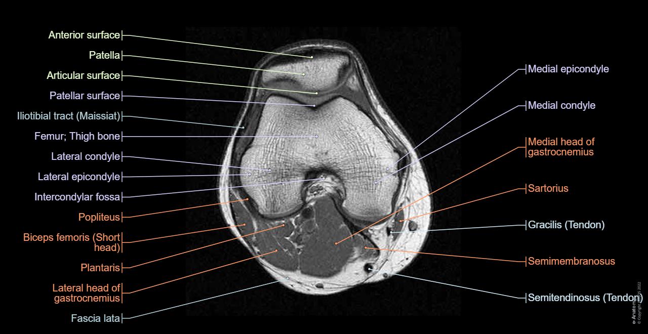 Normal Acl Radiopaedia Normal Mri Knee Normal MRI Knee | Radiology Case | Radiopaedia.org