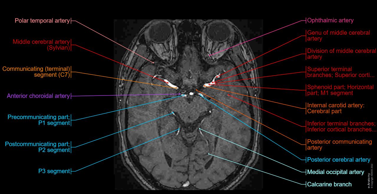 Axial MRI with labeled Circle of Willis vessels