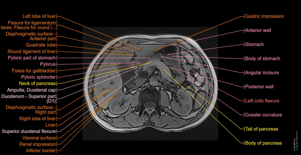 Pancake Sign Radiopedia Radiopedia Anular Do Pancreas