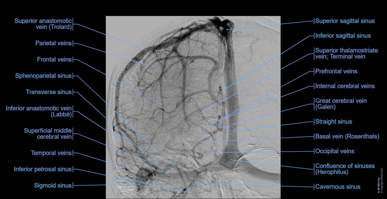 Angiogram Labelled Mri Brain Angio Anatomy Brain And Neck Arteries, 3D CT Angiogram