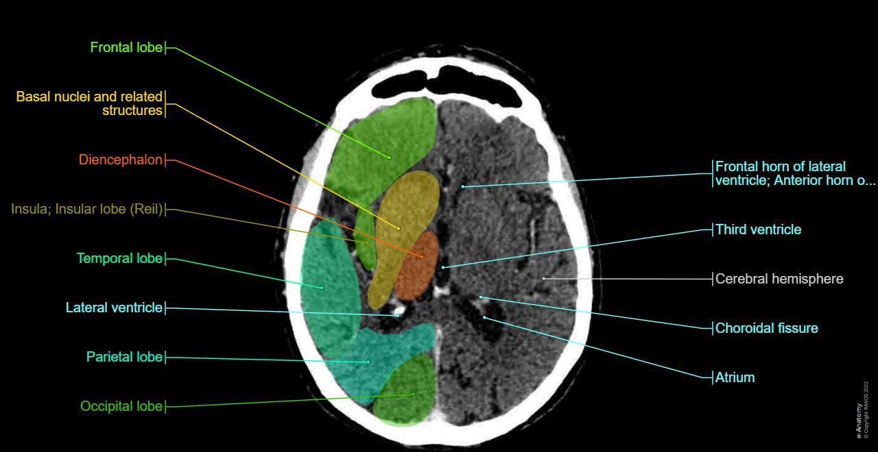 Anatomy of the brain and face: labeled CT - e-Anatomy