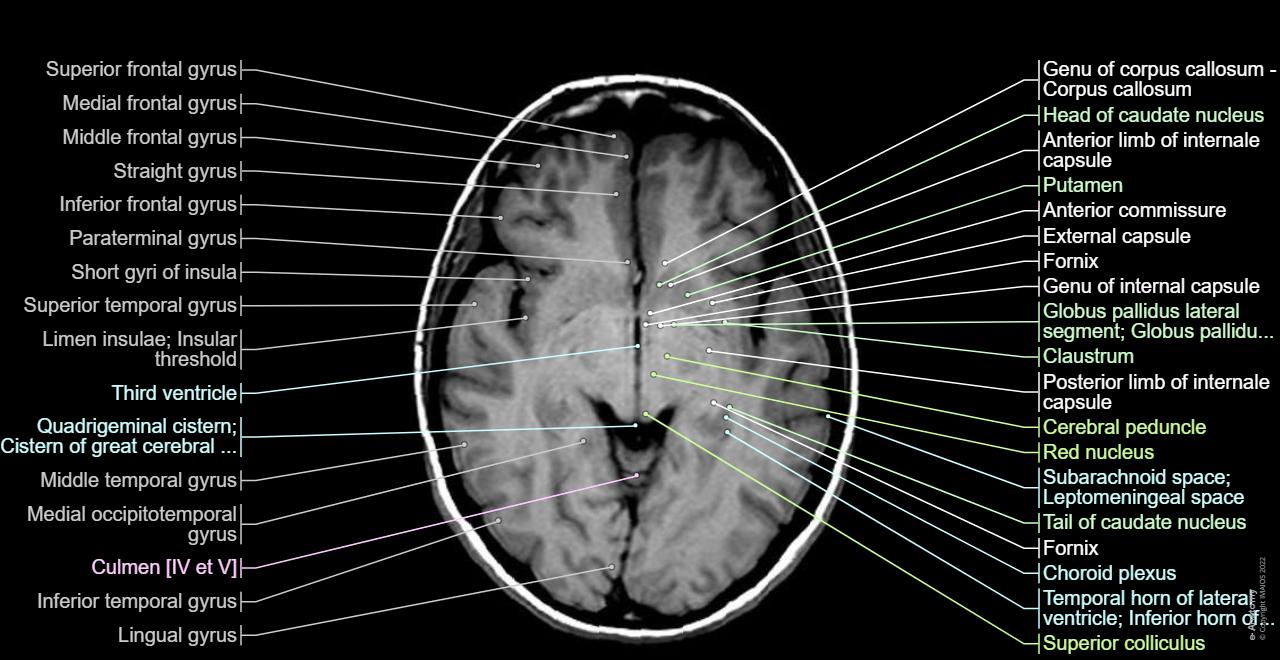 Cross-sectional anatomy of the brain: normal anatomy | e-Anatomy