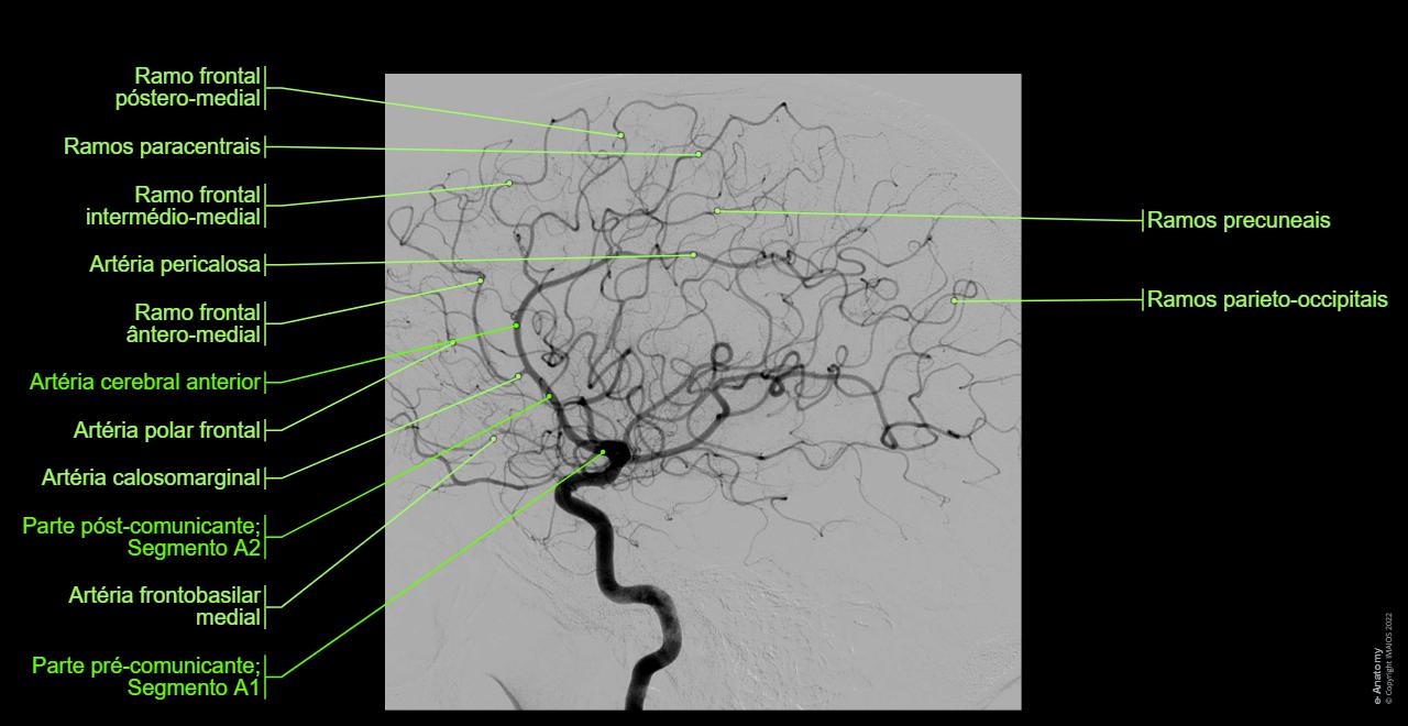 Normal Dsa Radiopaedia Anatomia Dos Ramos Da Arteria Carotida Interna VASCULARIZAÇÃO