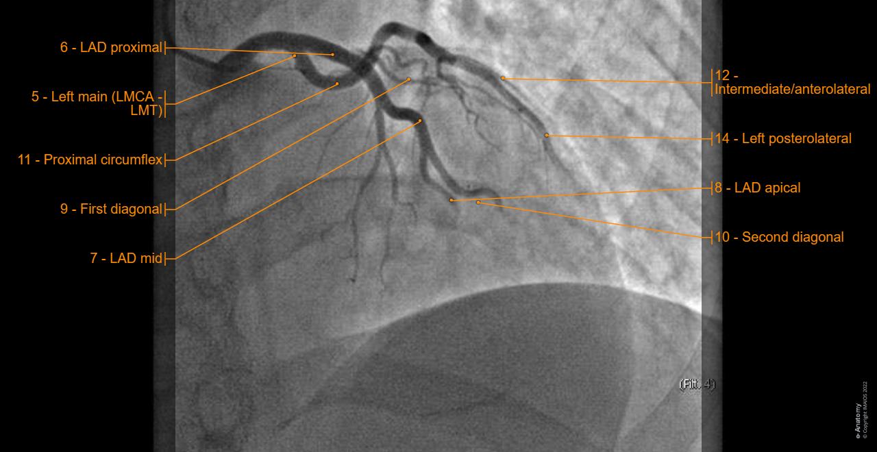 Normal Coronary Anatomy Coronary Artery Anomalies And Clinically