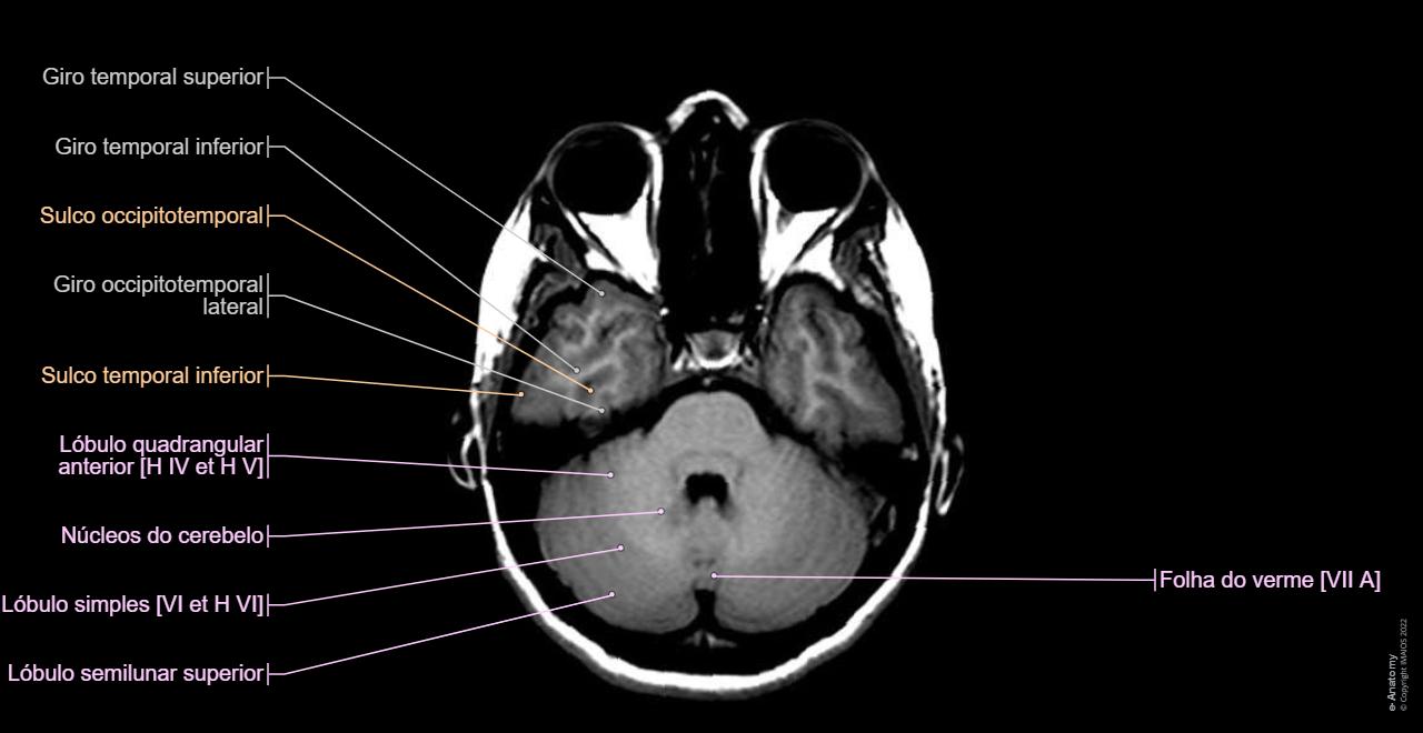Pont Rx Cérebro IRM : anatomia normal | e-Anatomy