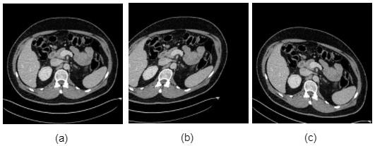 Shearing Augmentation Deep learning in medical imaging: data augmentation