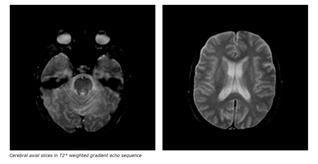 MRI Sequences: spoiled gradient echo sequences | e-MRI