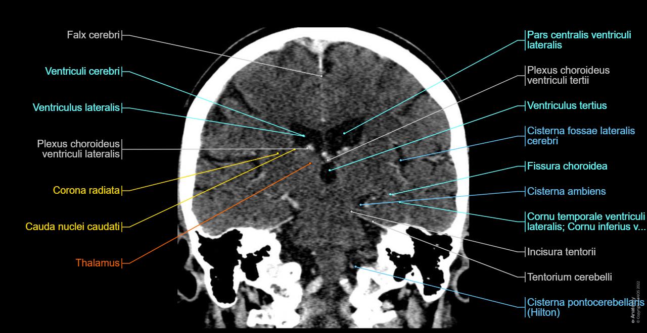 Cts Brain Schädel CT : normale anatomie | e-Anatomy