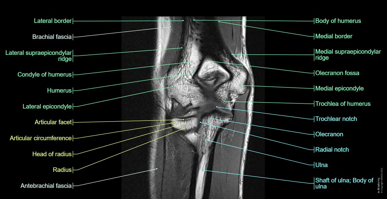 Normal Elbow Ct Scan Elbow CT arthrography: normal anatomy | e-Anatomy