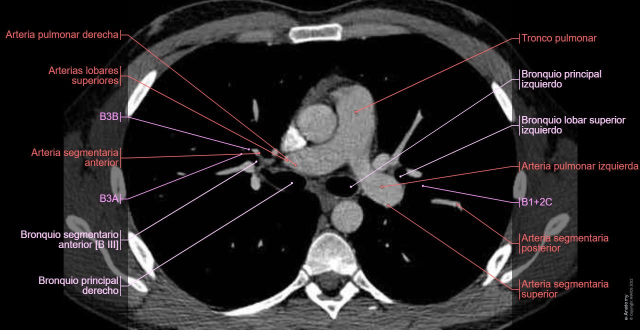 Tac Normal Anatomía De La Tomografía Computarizada Del Tórax Toracostomía Con