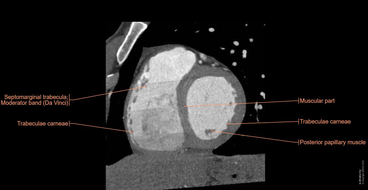 Ct Heart Anatomy Heart CT Scan: Purpose, Procedure & Risks