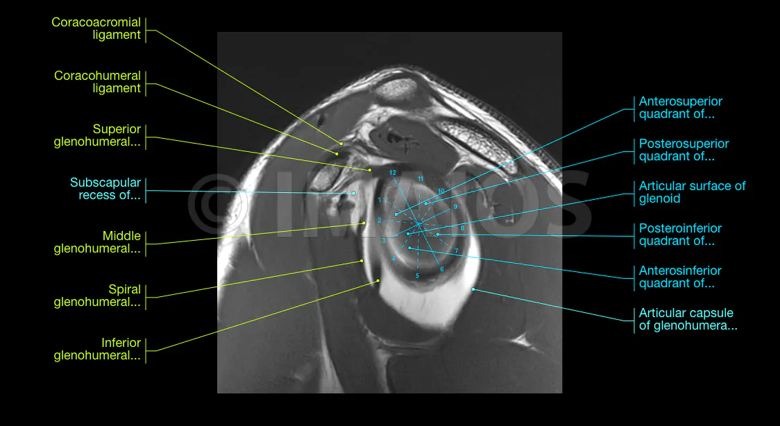 Shoulder MR Arthrogram | e-Anatomy