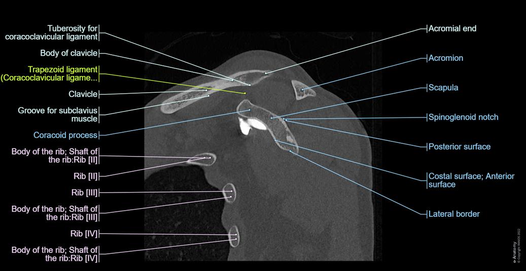 Shoulder Arthrogram Approach Artrogramma TC dell’articolazione della spalla: anatomia normale| e-Anatomy