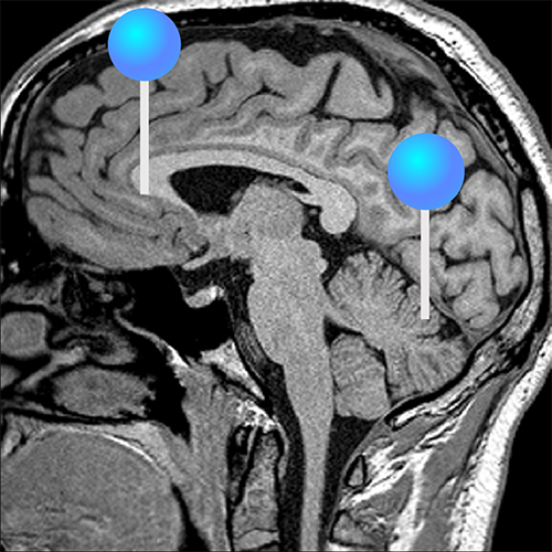 Normal Brain Scan