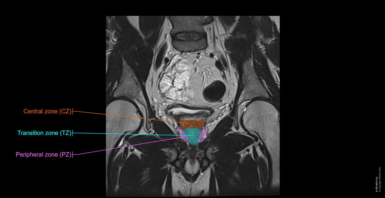 Prostate Coronal View Prostate Mri Anatomy PET/MRI Technique Shows Promise For Prostate