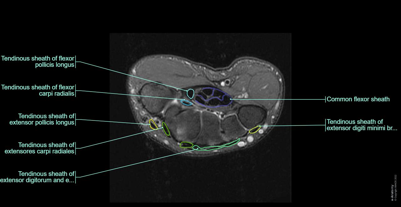 Hand Injection Mri Hand Mri Anatomy