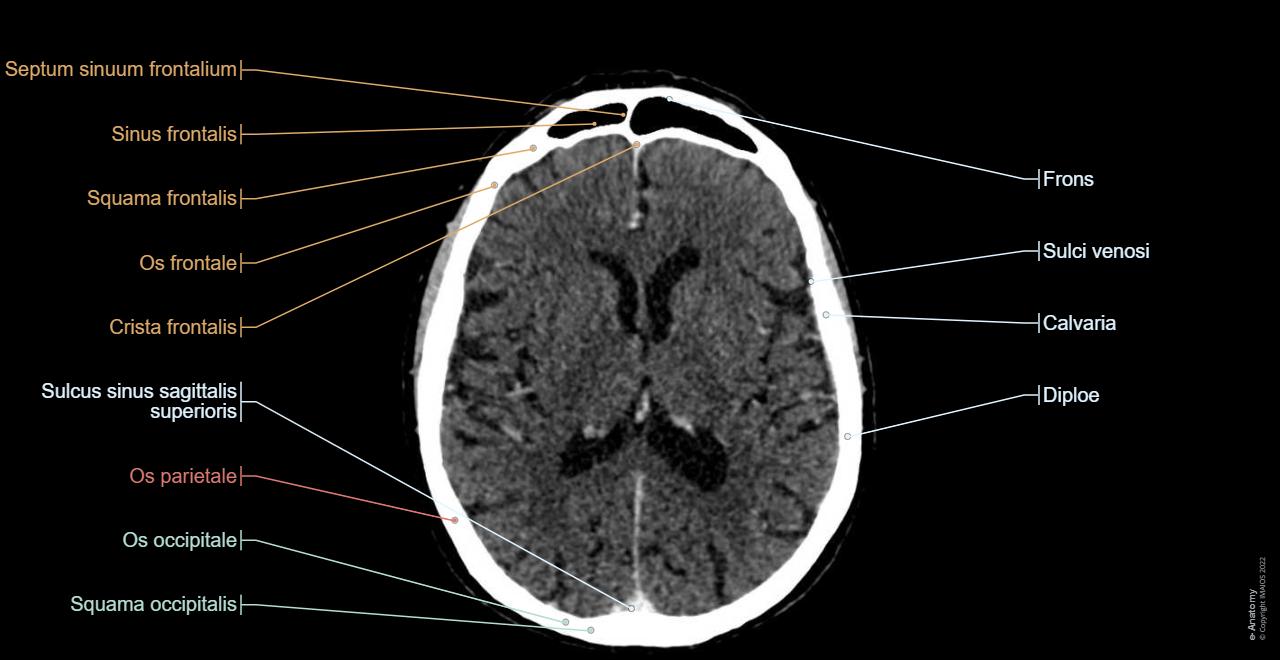 Cts Brain Schädel CT : normale anatomie | e-Anatomy