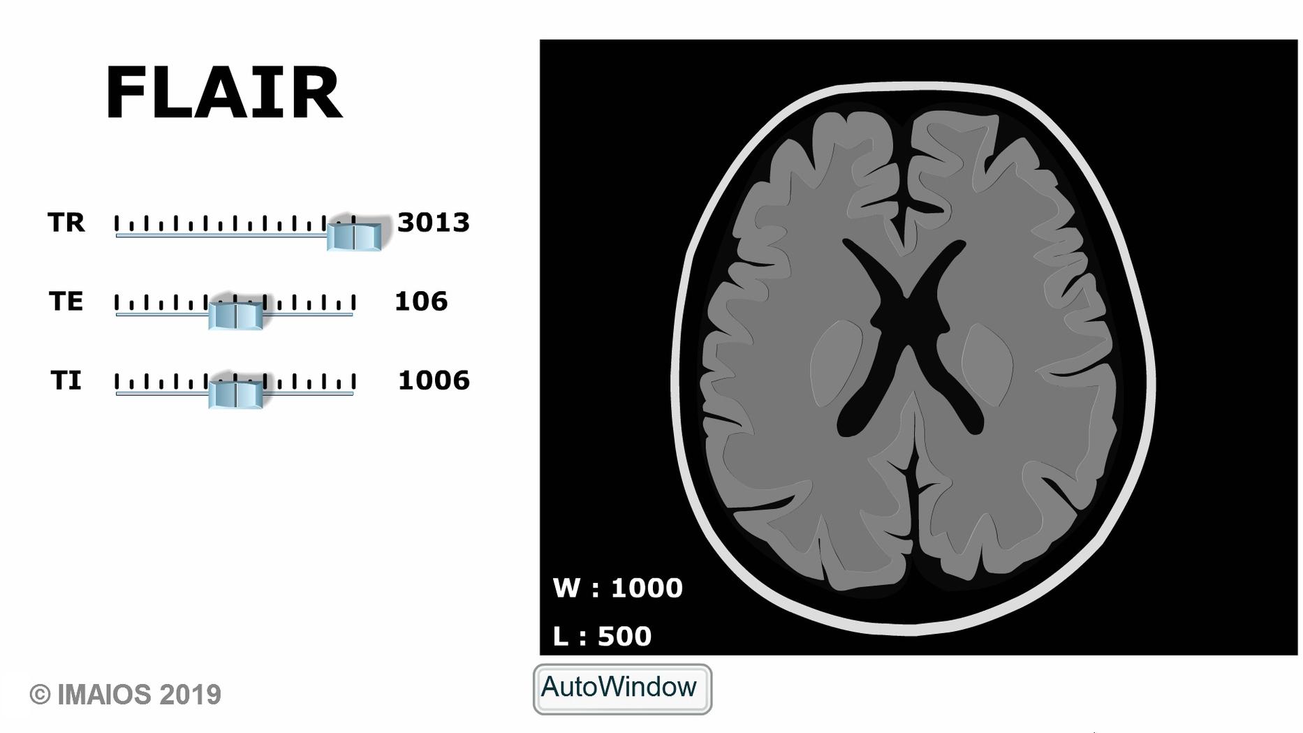 MRI sequences: Inversion Recovery, STIR and FLAIR | e-MRI