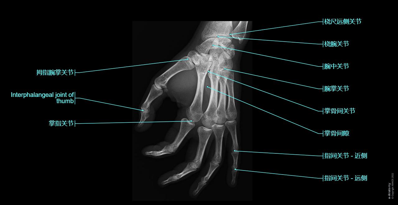 肩、手臂、前臂、手腕、手和和手指X光解剖图 : 带别针 | e-Anatomy