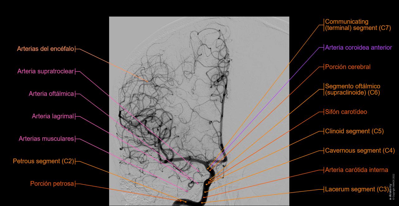 Normal Dsa Radiopaedia Anatomía De La Arteria Cerebral