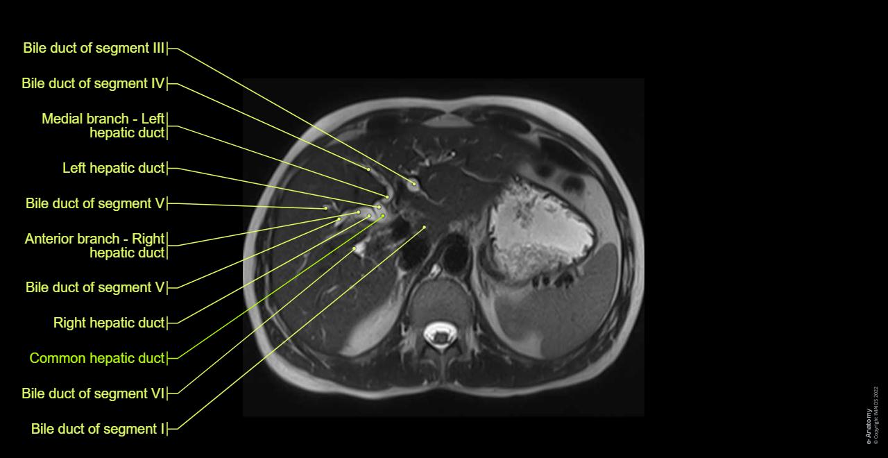 Magnetic Resonance Cholangiopancreatography: normal anatomy | e-Anatomy