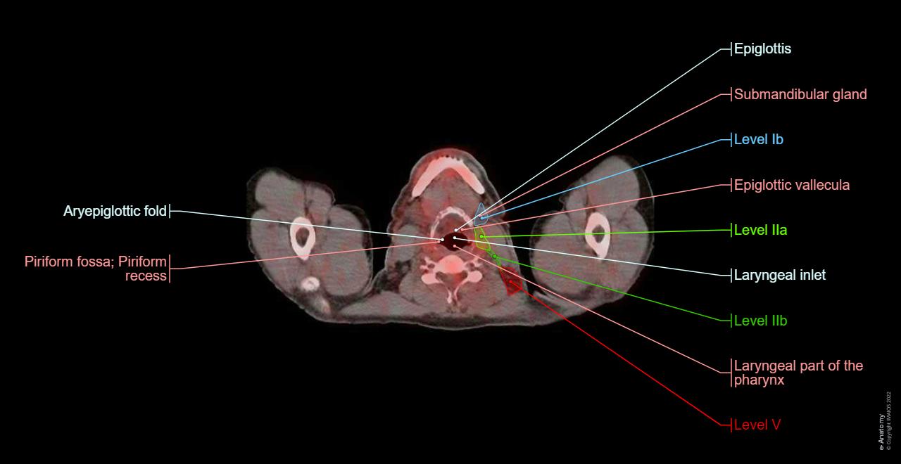 Pet Scan Structure Whole-Body PET-CT: normal anatomy | e-Anatomy