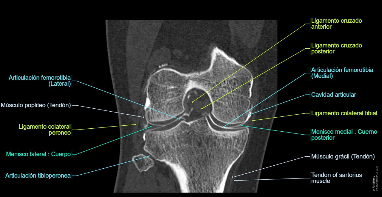 Rodilla Artrografía TC : anatomía normal | e-Anatomy