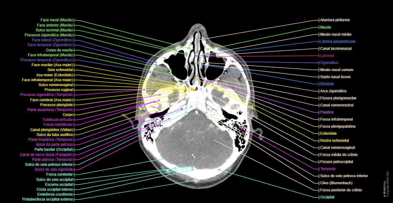 Linfonodo Occipital Duro Linfonodo occipital duro