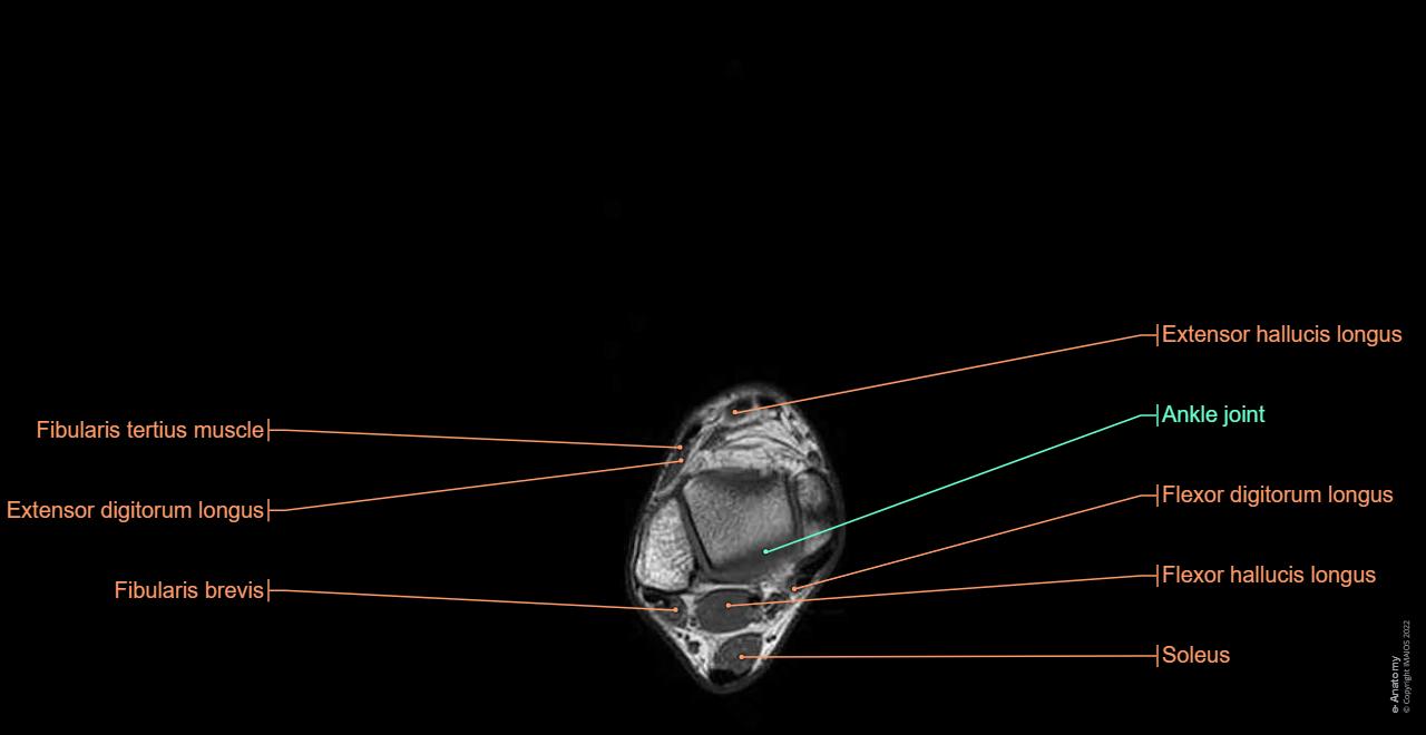 Anatomy of the foot and ankle - MRI | e-Anatomy