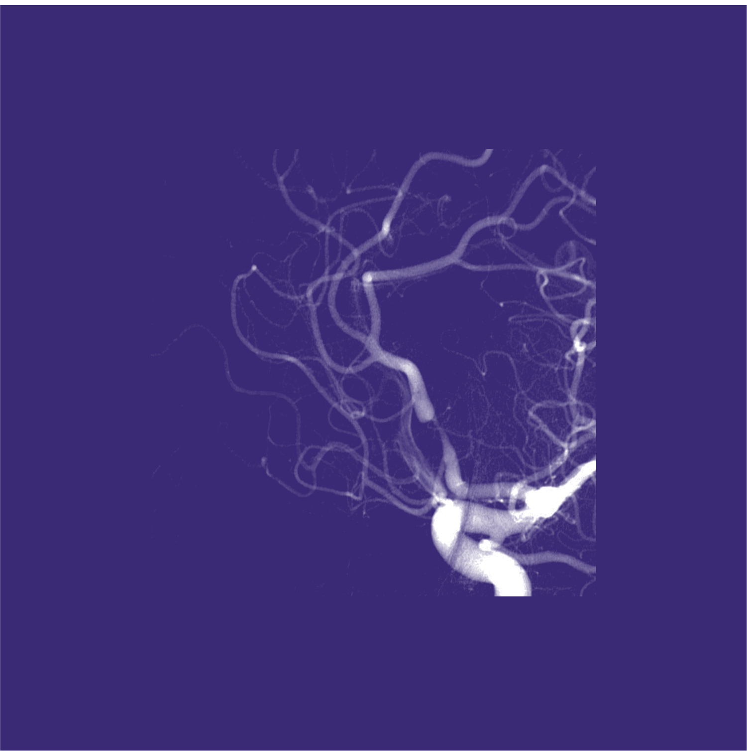 MRA and Flow MRI: flow compensation | e-MRI