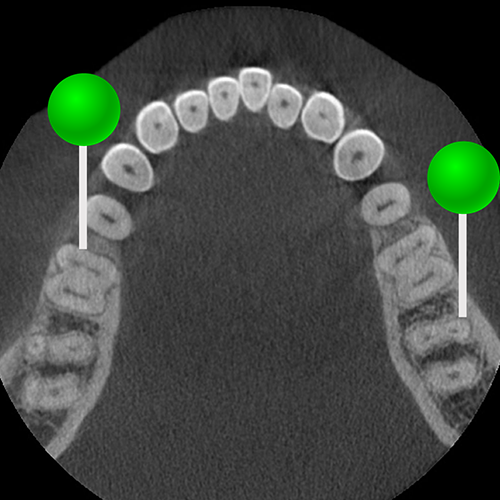 Cbct Scan Example Anatomy of the teeth: annotated dental-CBCT | e-Anatomy