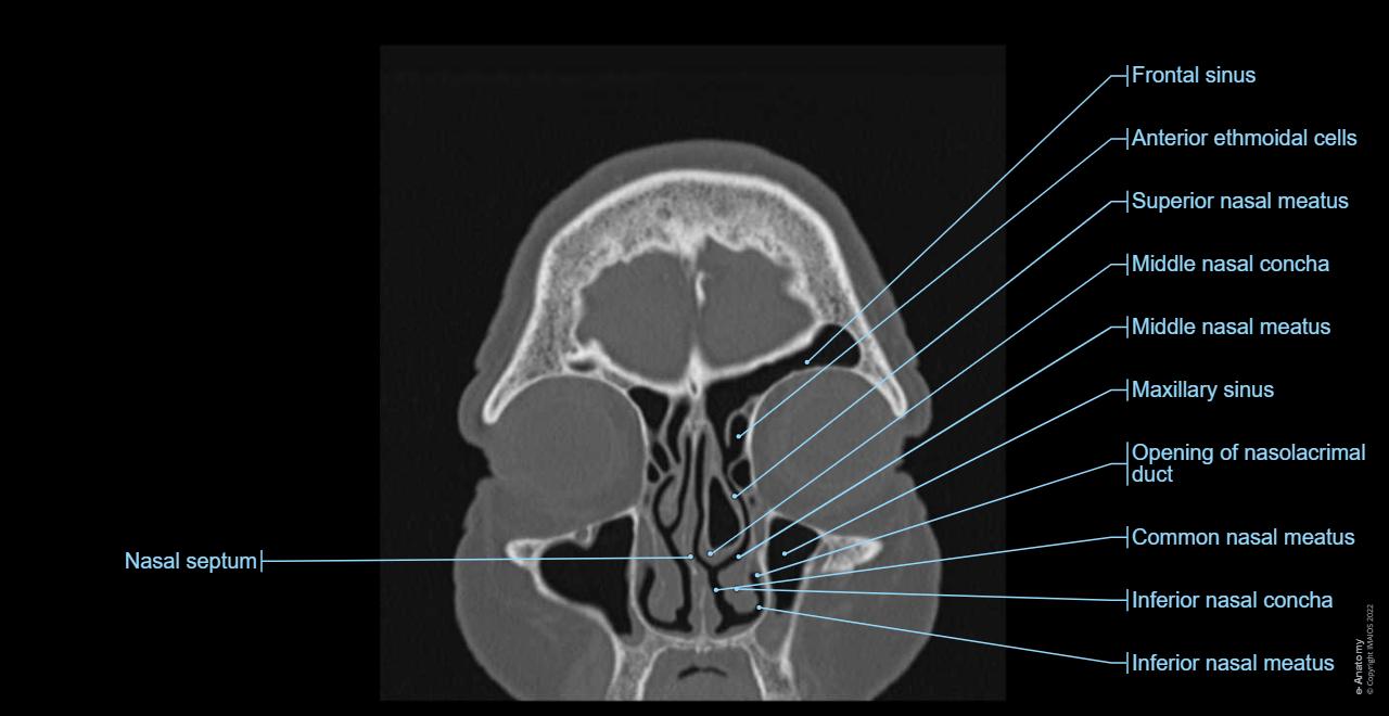 Anatomy of the brain and face: labeled CT - e-Anatomy
